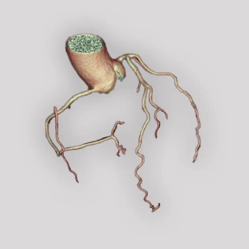 Ct Coronary Artery Calcium Scoring Queen Square Imaging Centre - Download Artistic City Background | HD