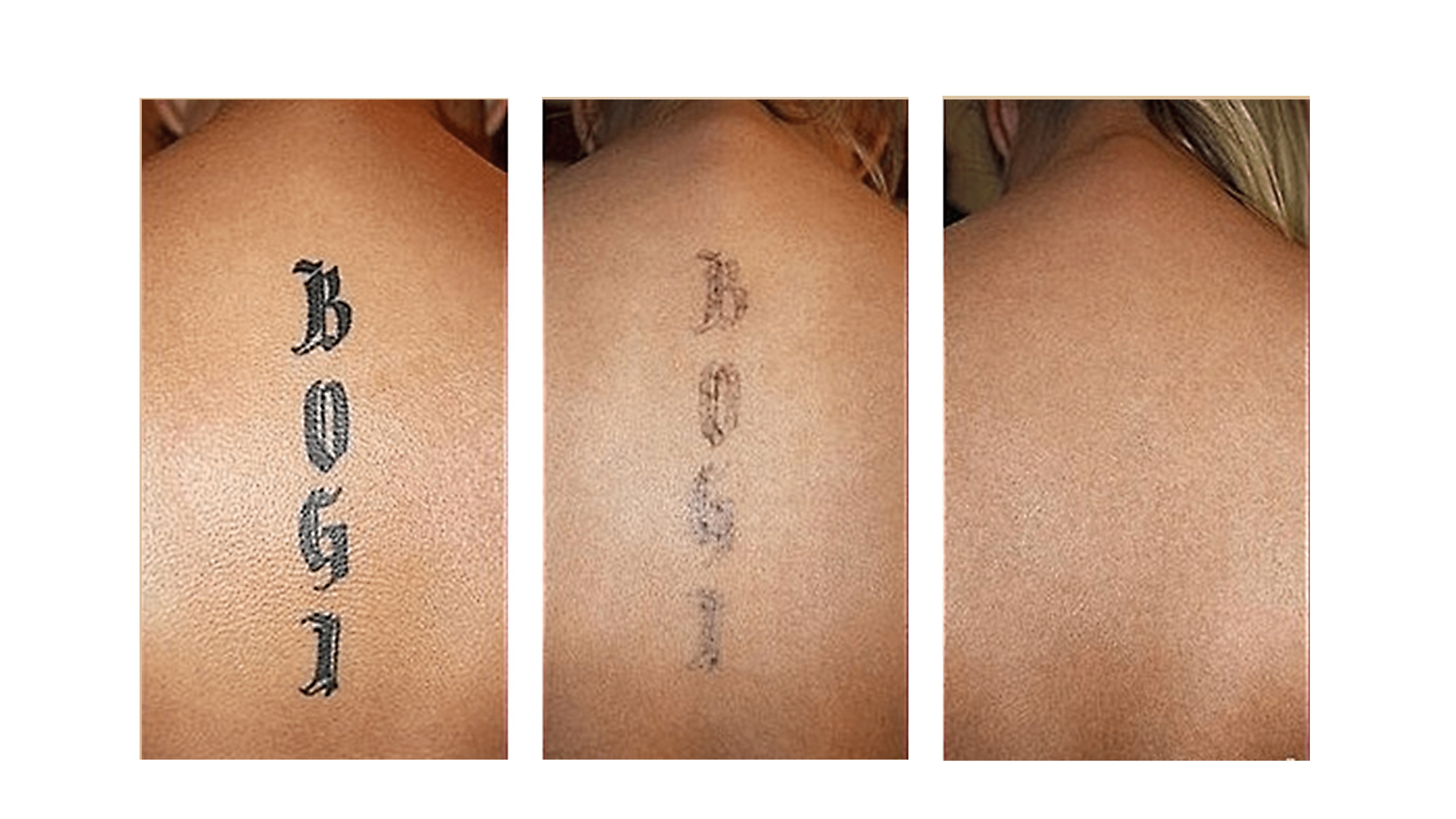 Rimozione Tatuaggi – Dott. Fabio Claudio Fasulo 2248_x_3995_png