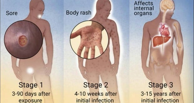 Syphilis disease