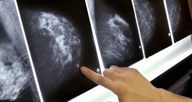 Mammograms