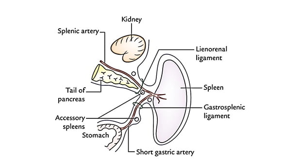 Accessory spleen