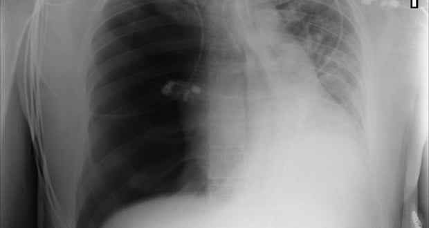 Pneumothorax