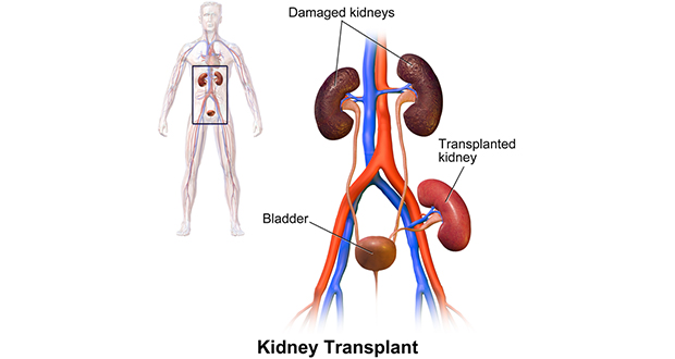 Kidney transplants
