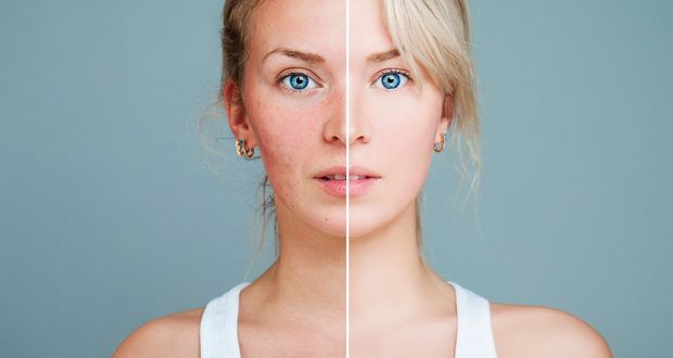 Rosacea
