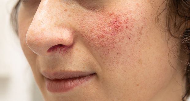 Rosacea 