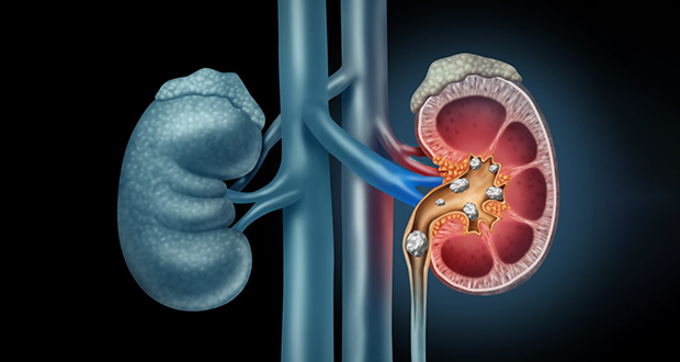 Kidney stones