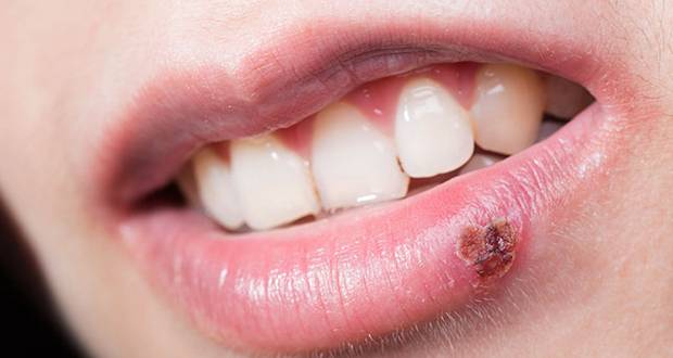 Cold Sores