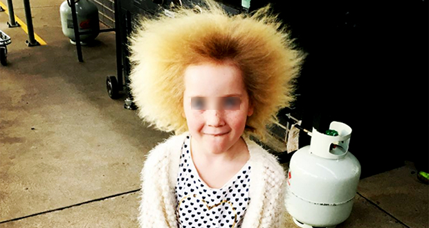 Uncombable Hair Syndrome