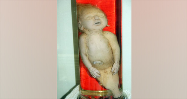 Mermaid Syndrome