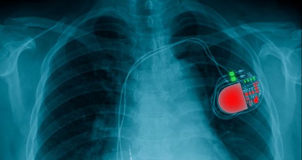 Pacemakers Exposed by Unencrypted Updates
