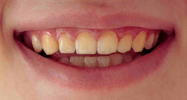 Why Strong Teeth Look Yellow