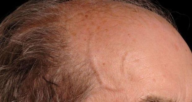 Thin Temples, Big Artery Risk