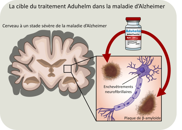 Quelle est l'efficacité du nouveau médicament contre la maladie d'Alzheimer - Aducanumab (nom commercial Aduhelm)?
