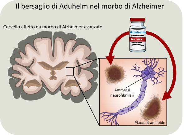 Quanto è efficace il nuovo farmaco per la malattia di Alzheimer – Aducanumab (nome commerciale Aduhelm)?
