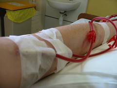 Plugged into dialysis Plugged into dialysis