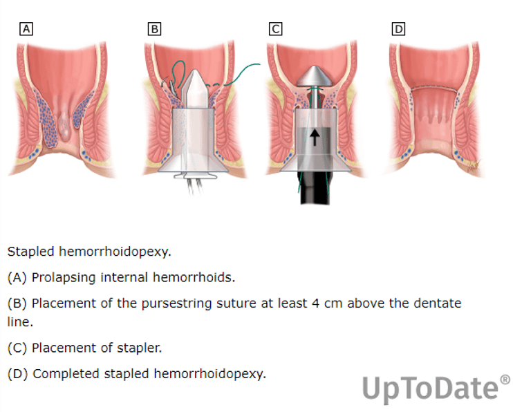 Quality of Life Recovery After Conservative Hemorrhoid Management Outcomes of Surgical vs. Conservative Care