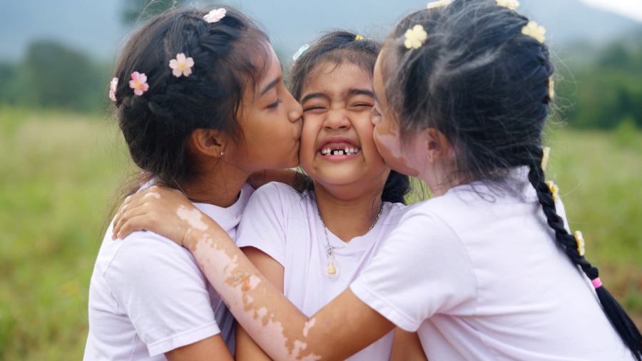 vitiligo