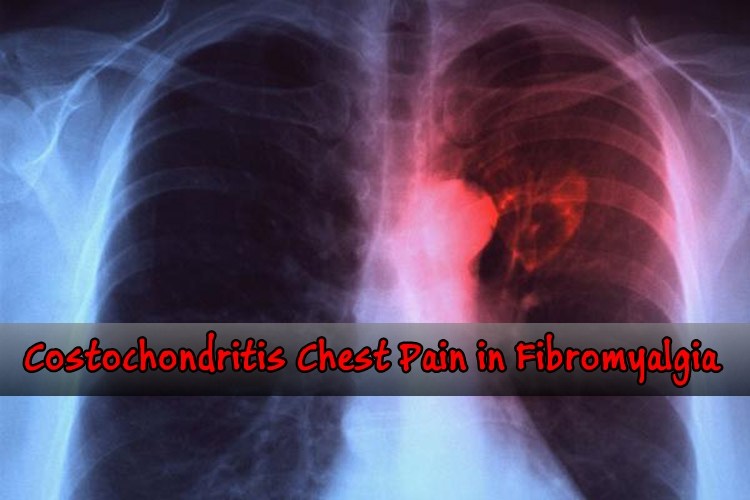» Should You Worry About Costochondritis Pain in Fibromyalgia?