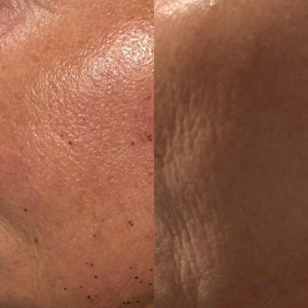 Fibroblast face tightening before and after, Perth