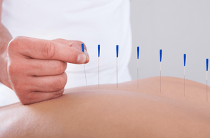 Acupuncture