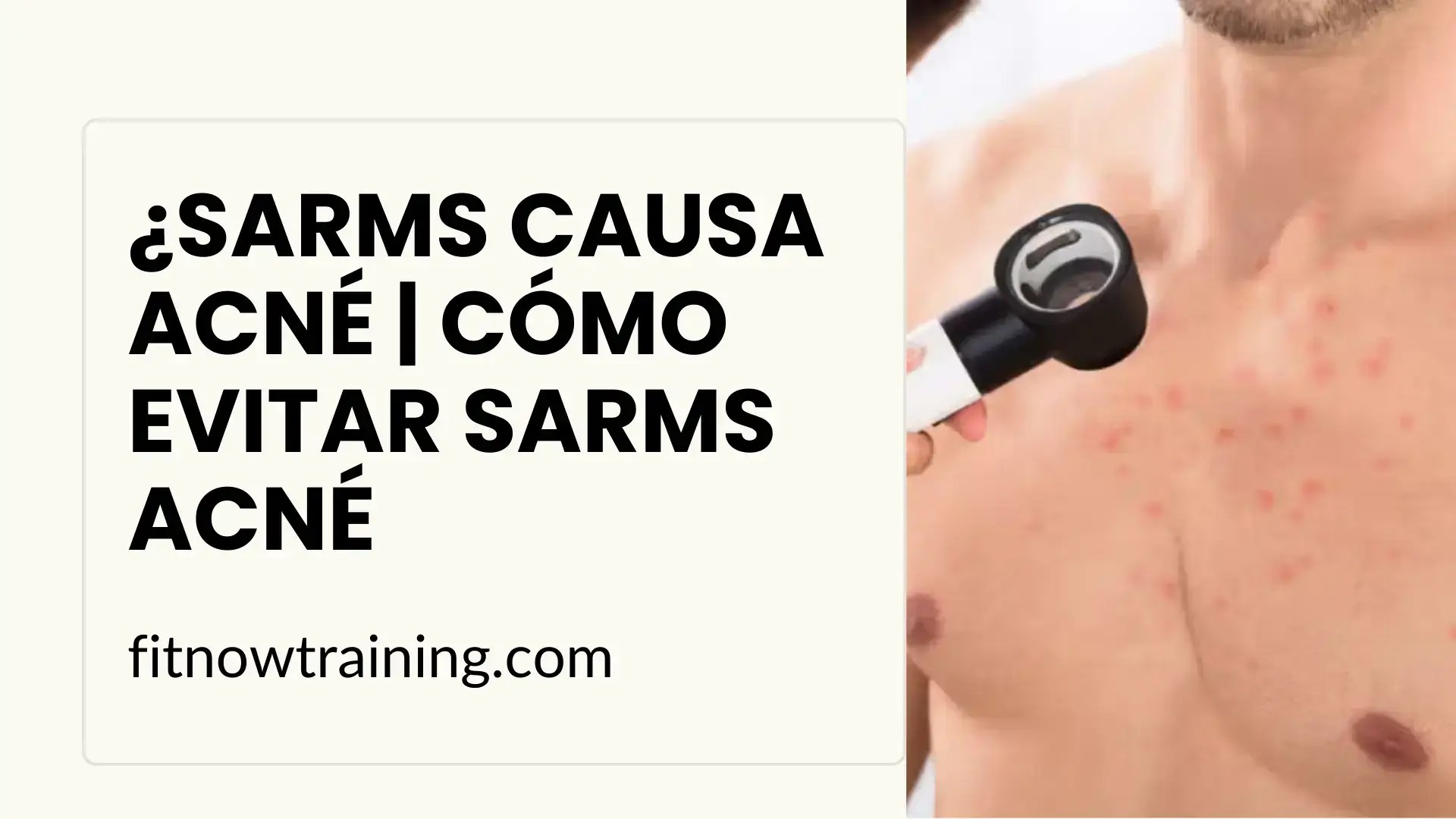 ¿sarms causa acné