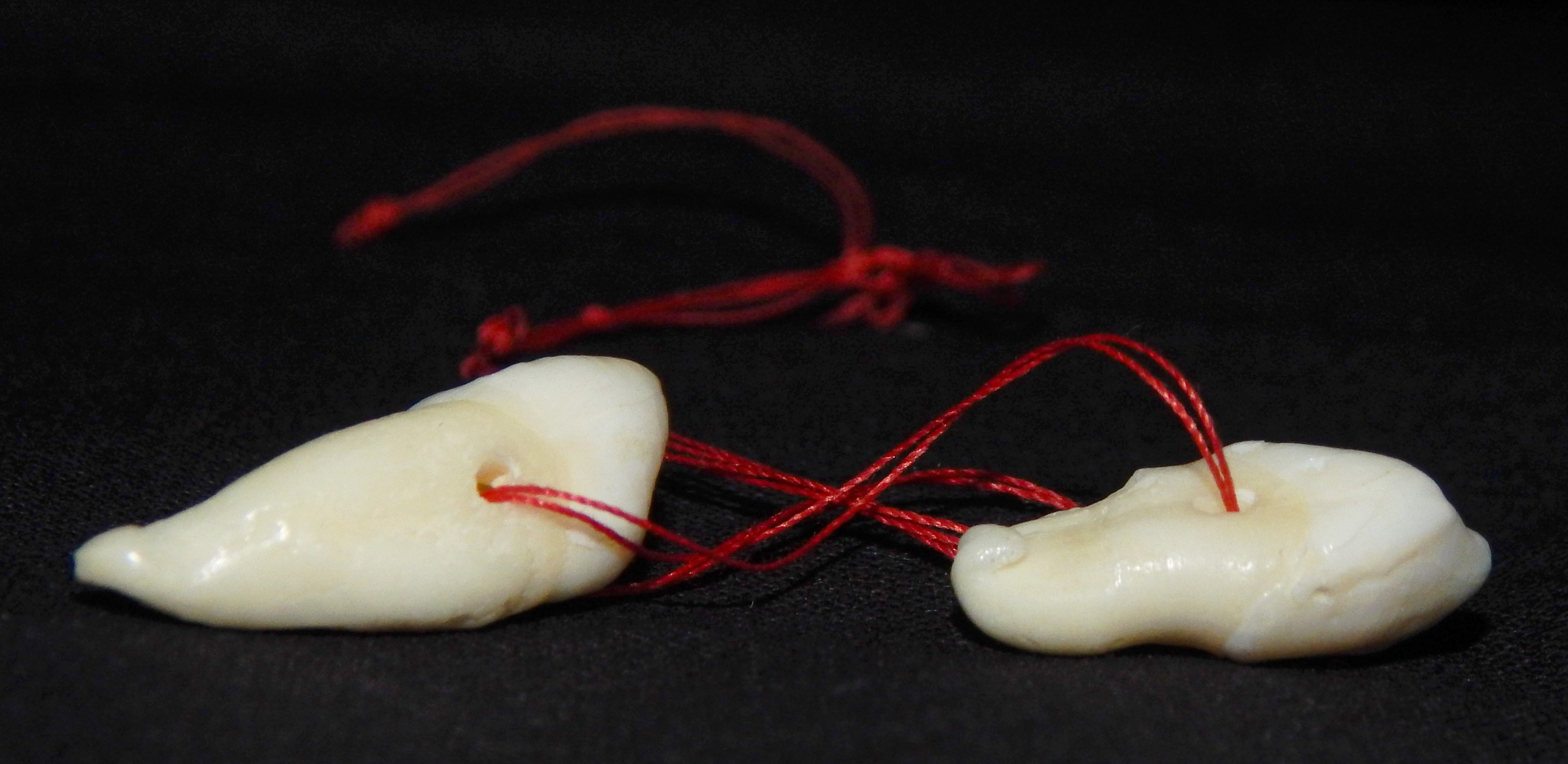 Human teeth extracted by oral surgeon Dr. Lorenzo Gonzalez