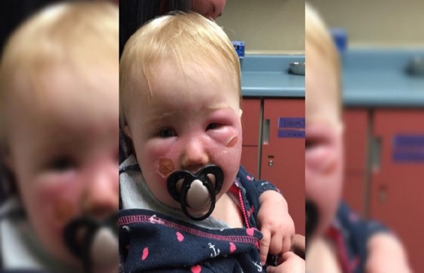 Bebê sofre queimaduras devido ao uso de protetor solar infantil