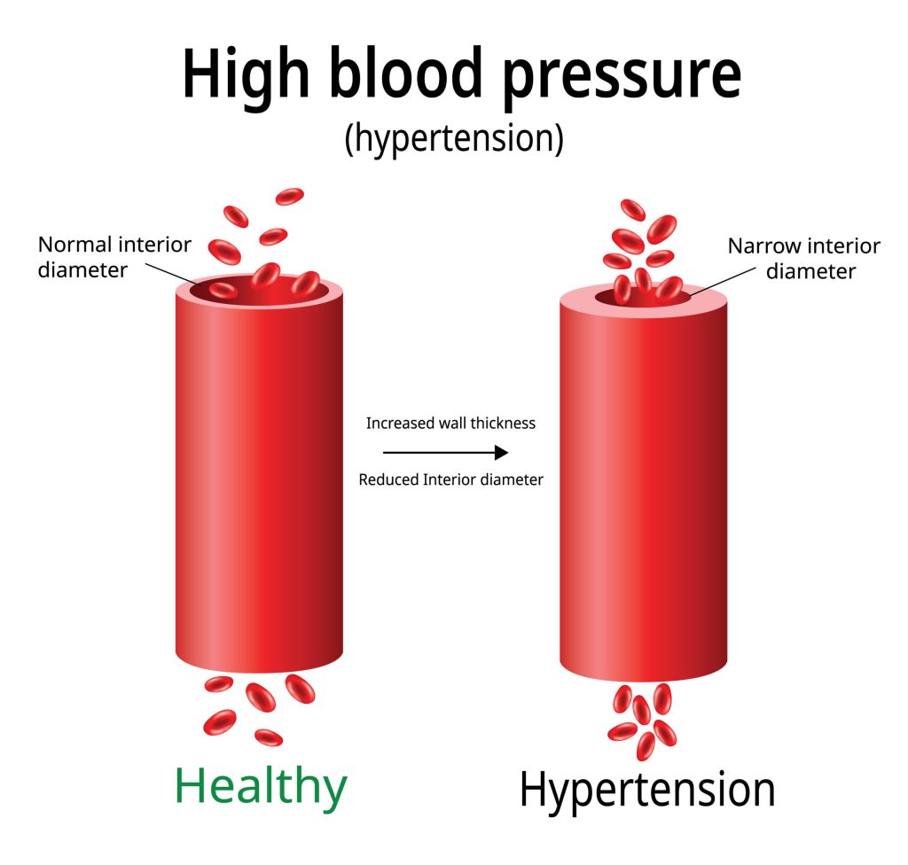 Blood Pressure
