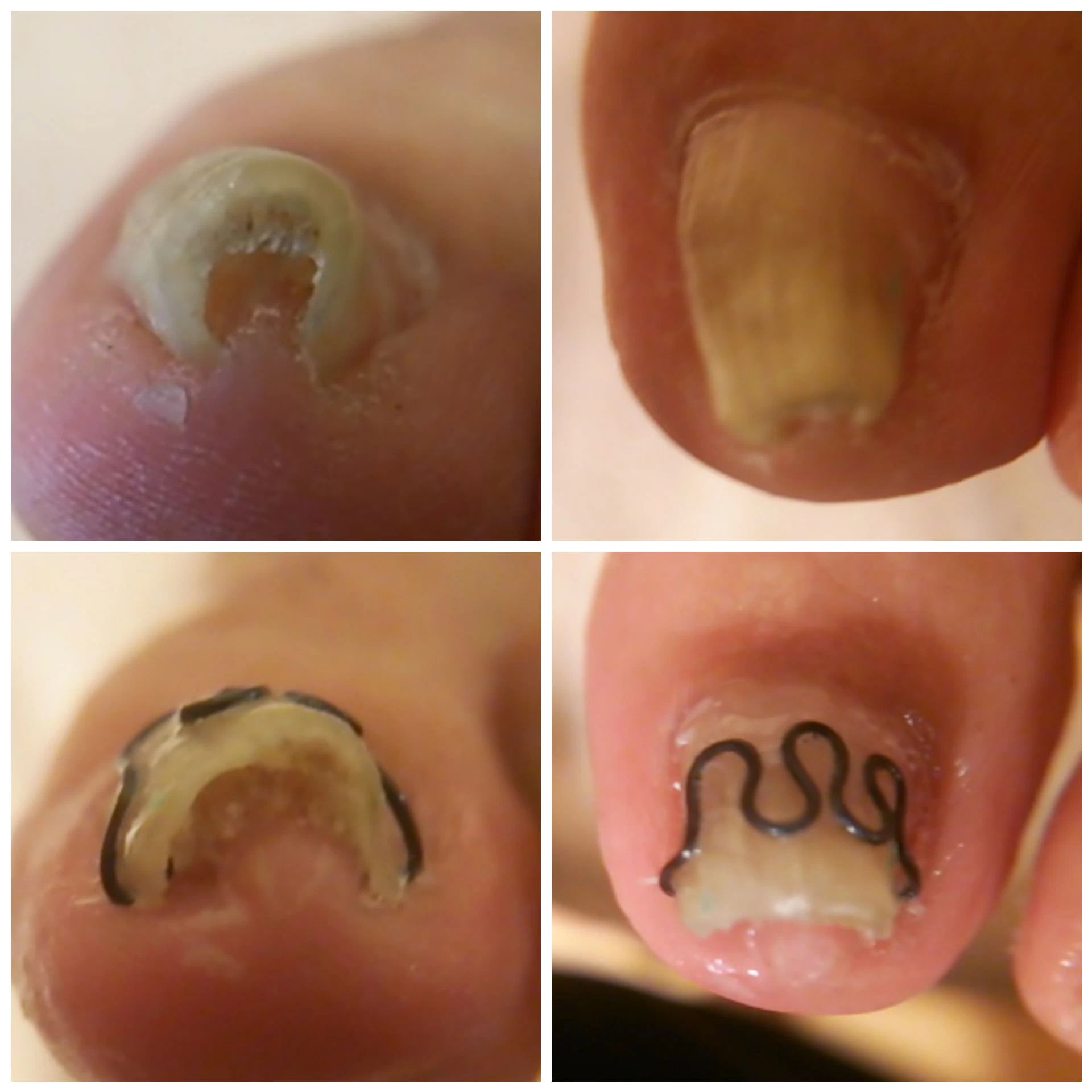 マチワイヤー、BSスパンゲVHOいろいろやってきました。 | 東京で巻き爪のケアを行うサロンから皆様のお役に立つブログを発信します