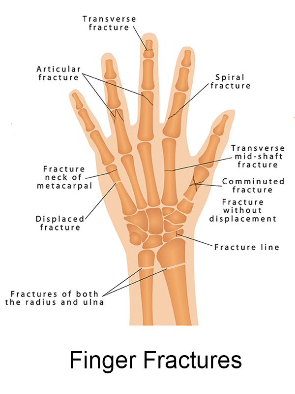 Hand Therapy Fremont Orthopedic Rehabilitation Medicine
