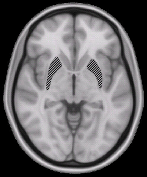 Pseudotumor Cerebri and Fluoroquinolones