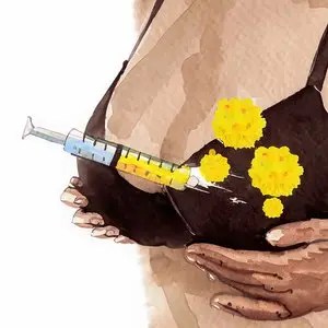 Illustration of fat transfer to the breast with a syringe