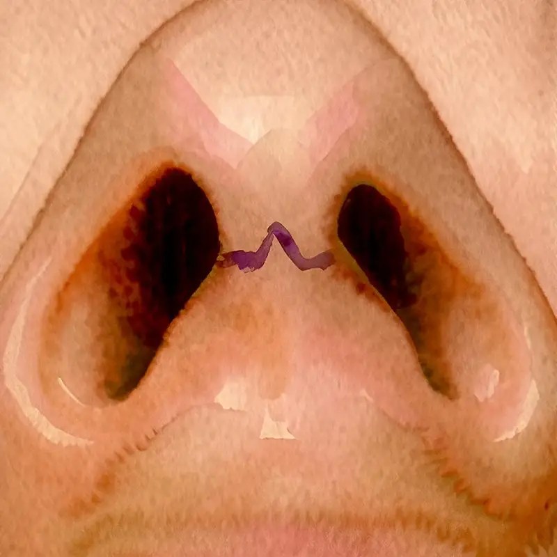 Mastering the Difference between Open and Closed Rhinoplasty