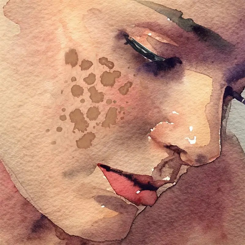 5 Expert Tips to Treat Melasma: Those Stubborn Brown Spots