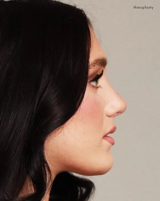 Rhinoplasty patient result in profile