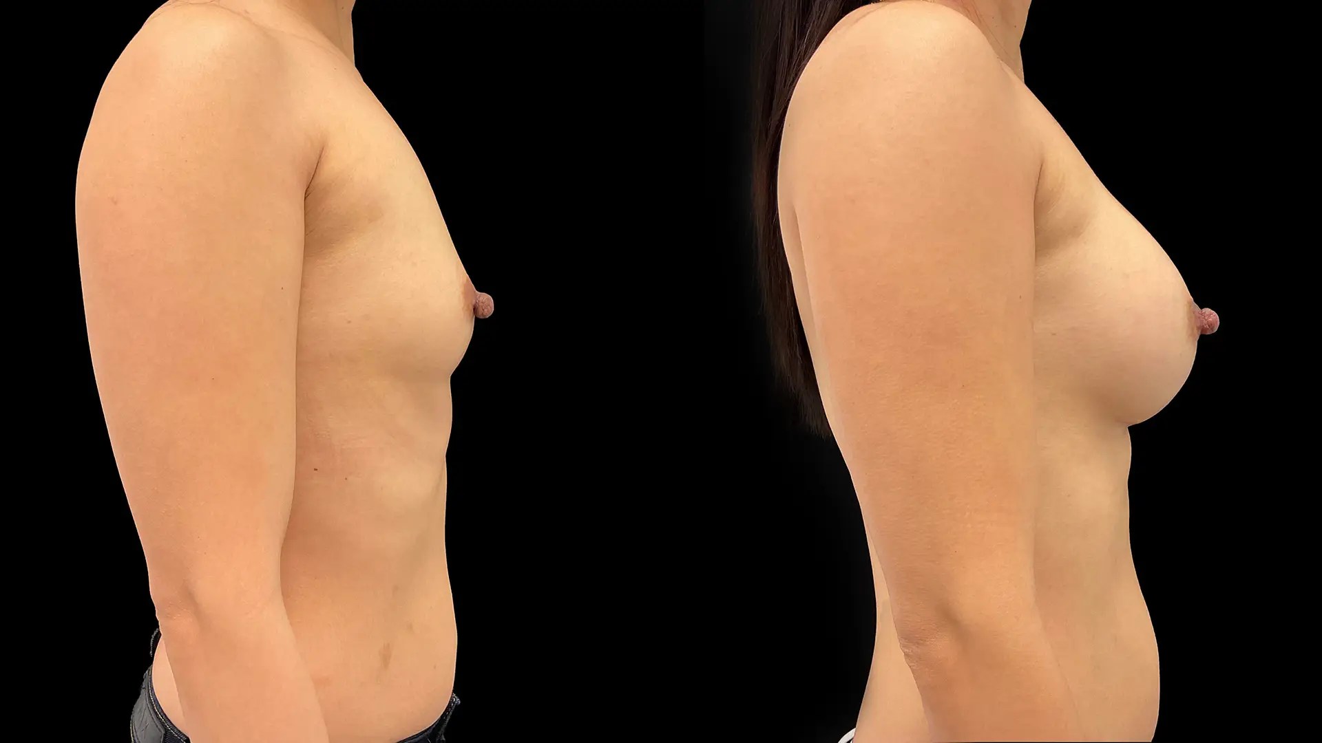 Breast augmentation before and after photos