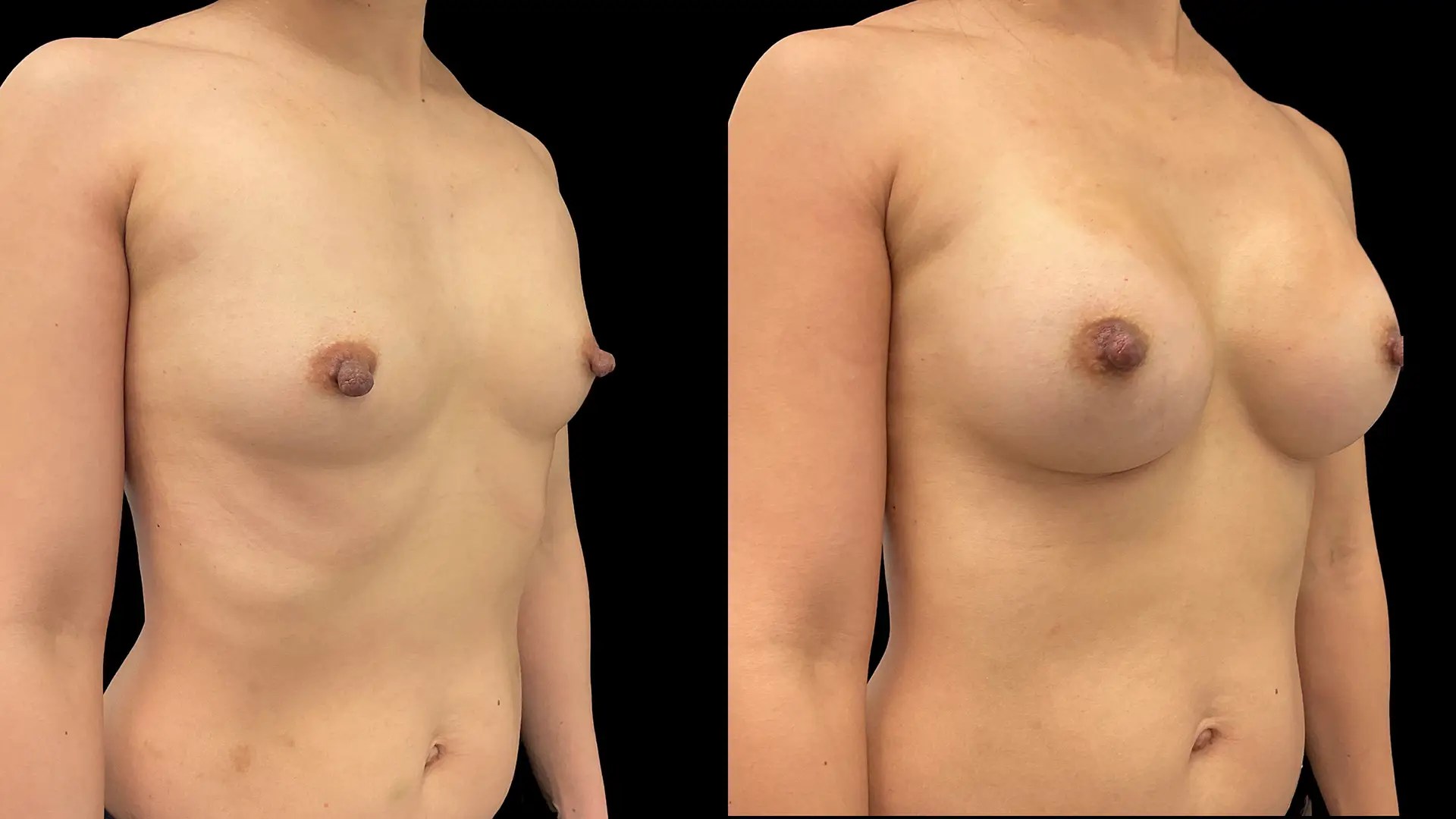 Breast augmentation before and after photos, right oblique view