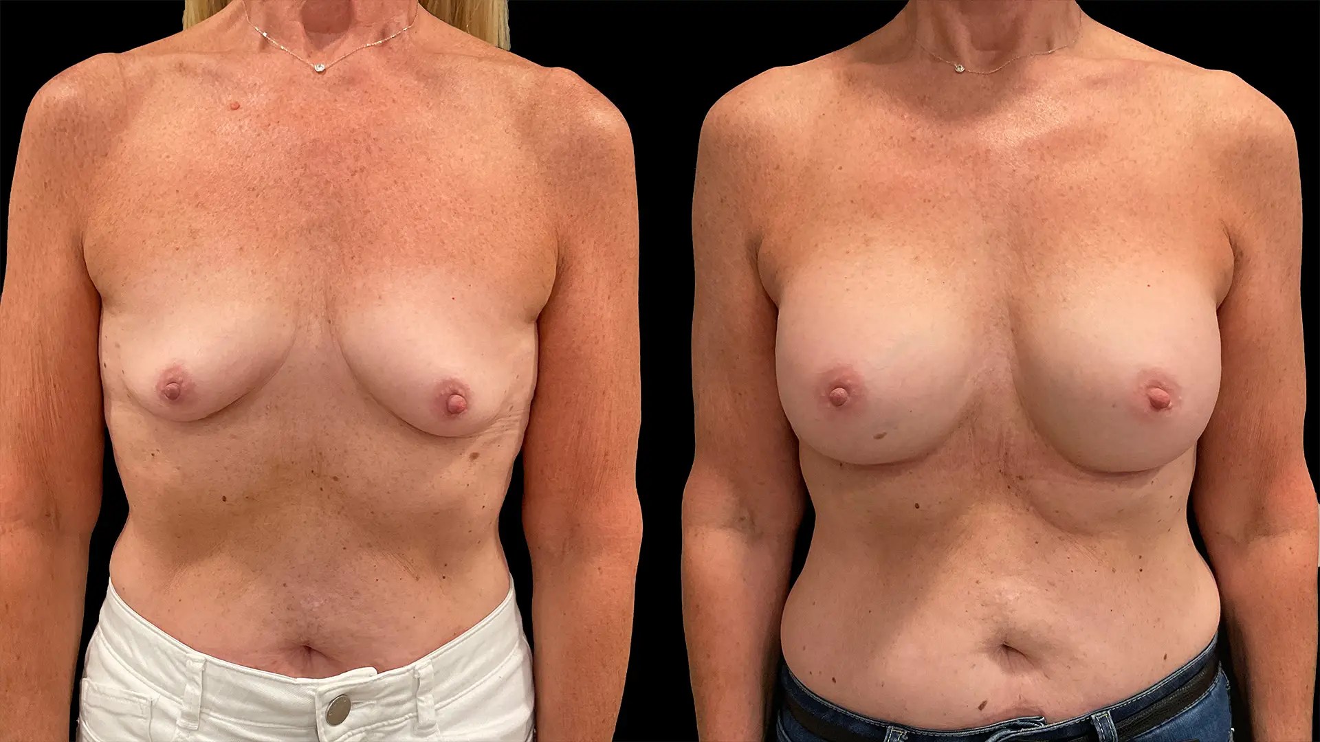 Breast augmentation before and after photos, front view