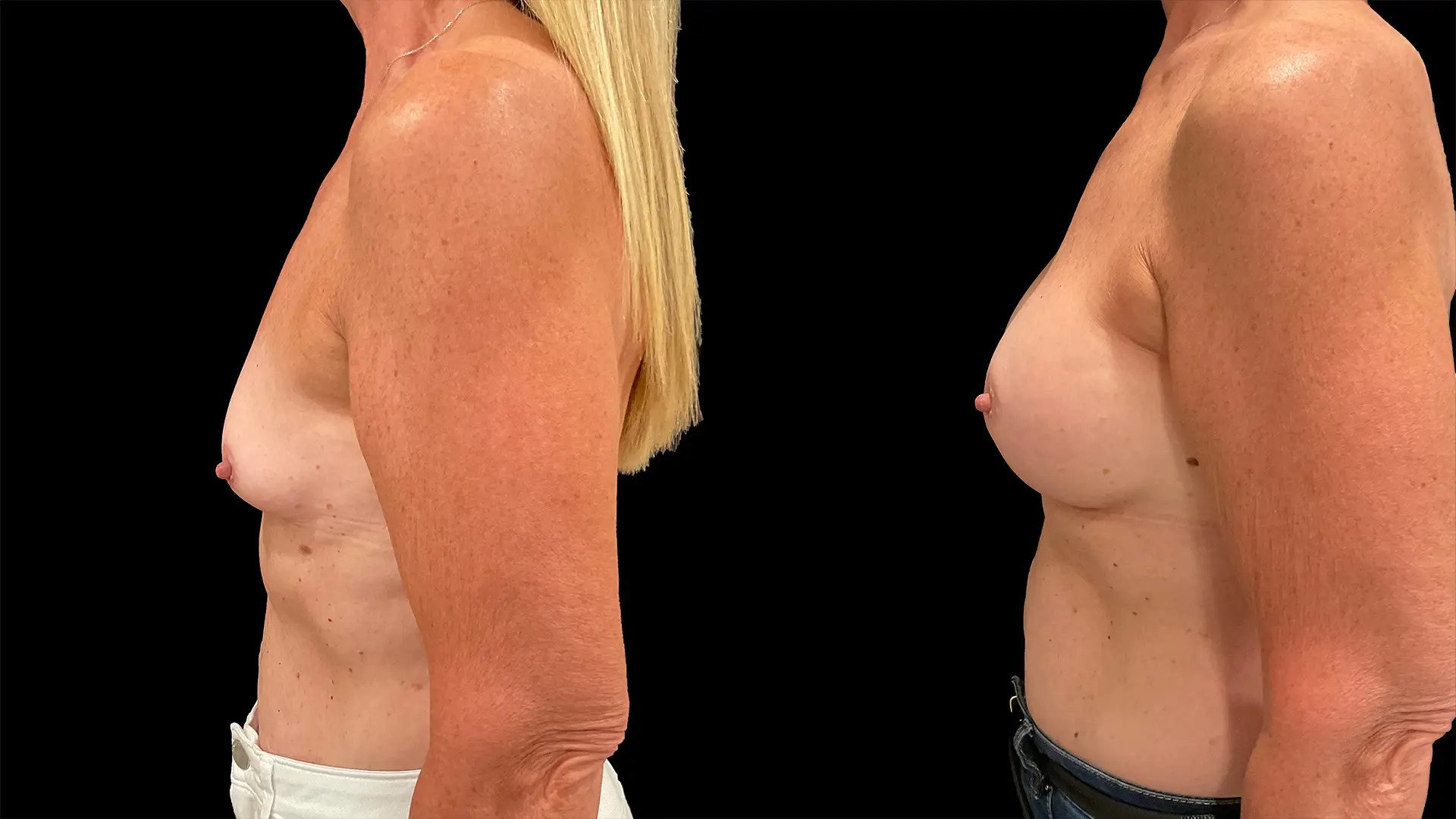 Breast augmentation before and after photos, left side view