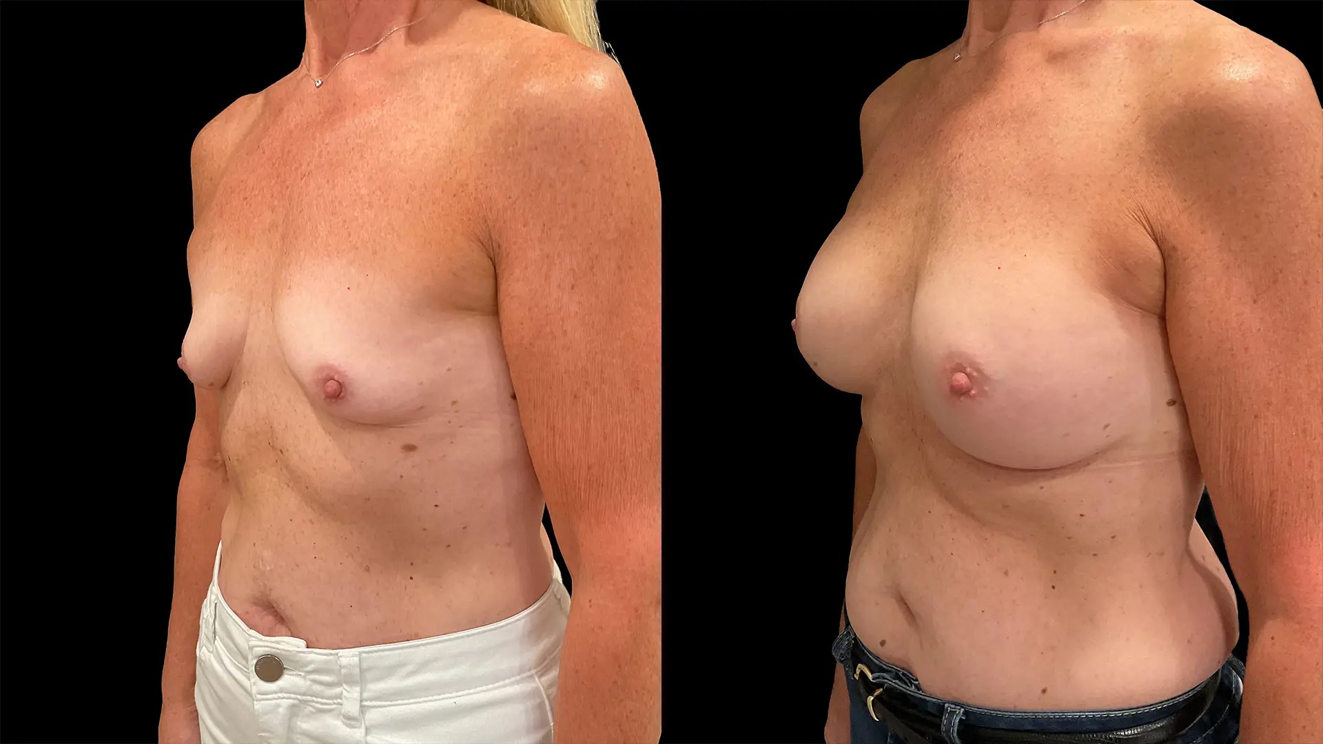 Breast augmentation before and after photos, left oblique view