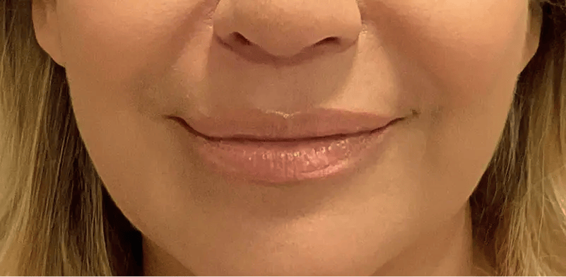Image of a woman's lips after lip lift surgery