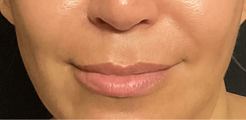 Image of a woman's lips before lip lift surgery