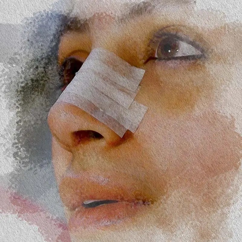 Nasal Taping after rhinoplasty illustration