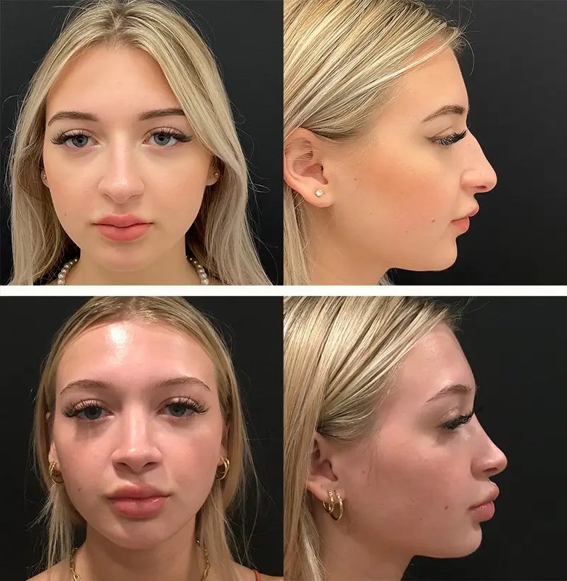 Rhinoplasty before and after photos, patient 102