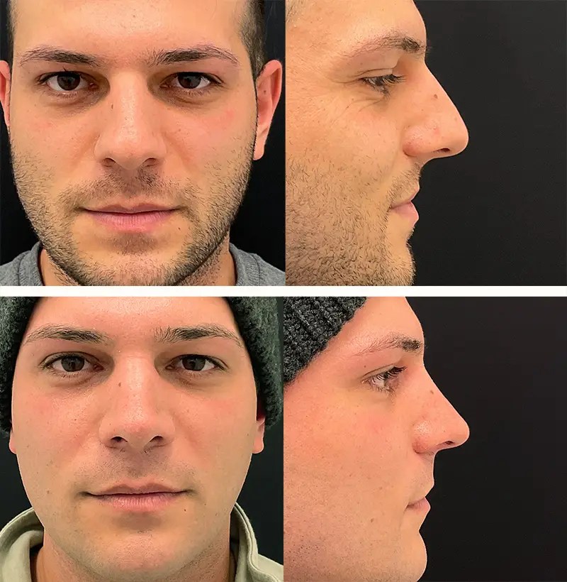 Male rhinoplasty before and after photos, patient 112