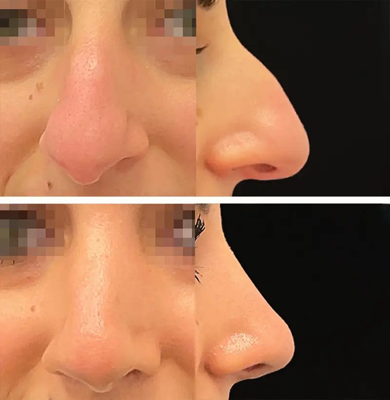 Rhinoplasty before and after photos, patient 122