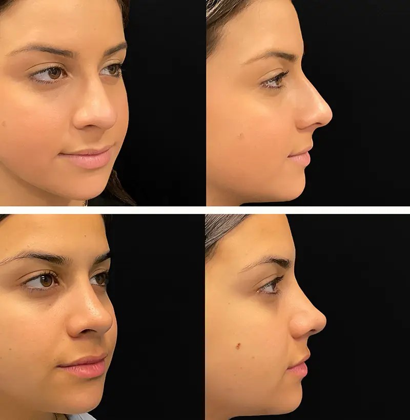 Rhinoplasty before and after photos, patient 201