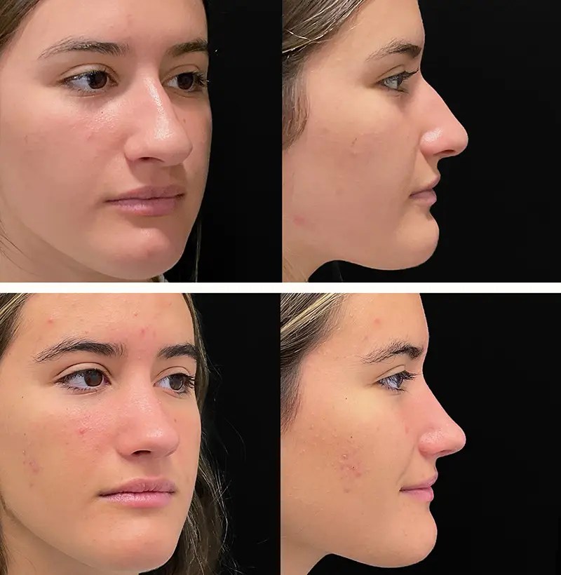 Rhinoplasty before and after photos, patient 76