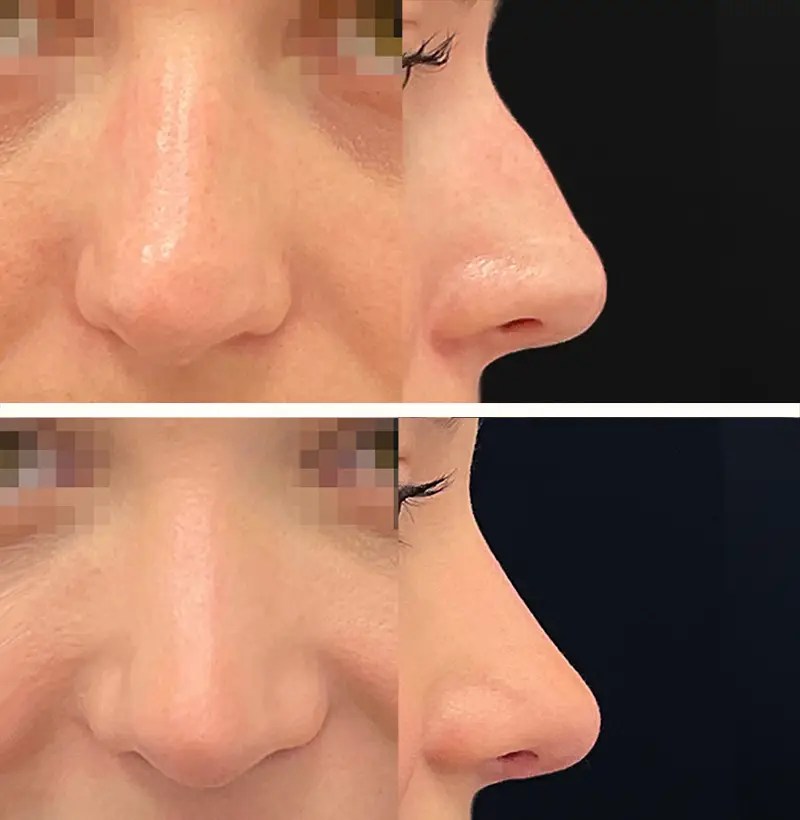 Rhinoplasty before and after photos, patient 82