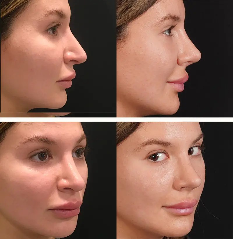 Revision rhinoplasty before and after photos, patient 86